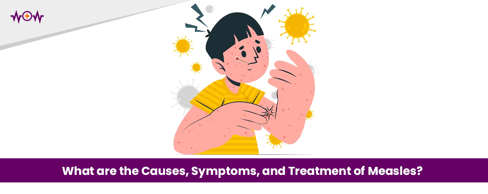 What are the Causes, Symptoms, and Treatment of Measles?