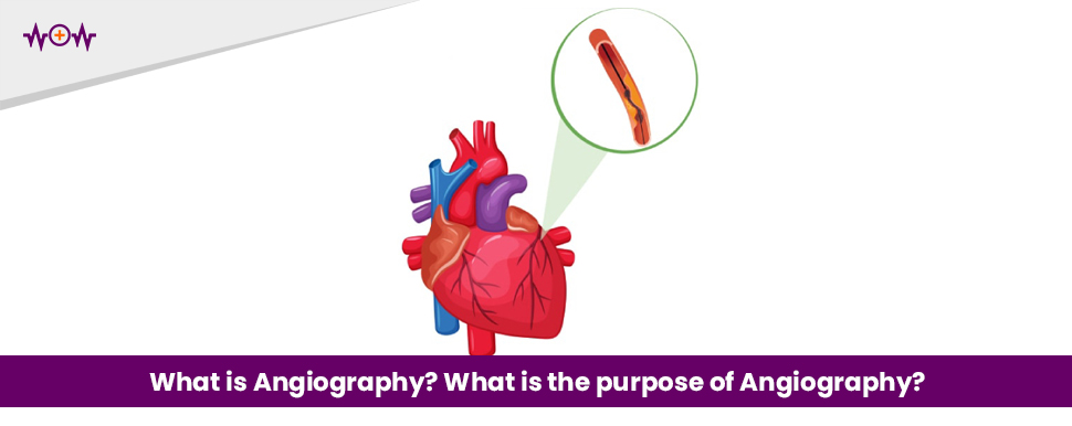 What is Angiography? What is the purpose of Angiography?